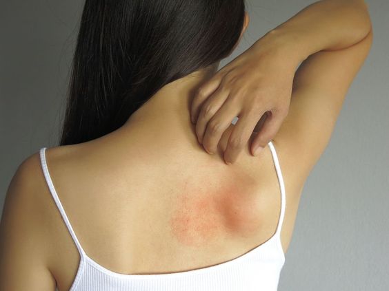Dealing with Prickly Heat Rash